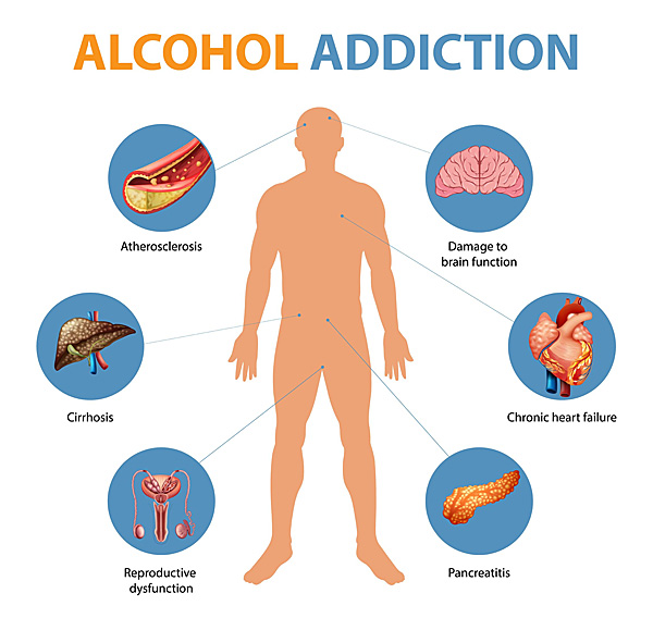 alcohol addiction